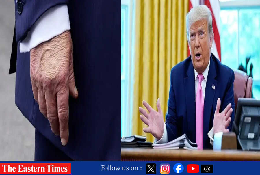 trump chronic disease